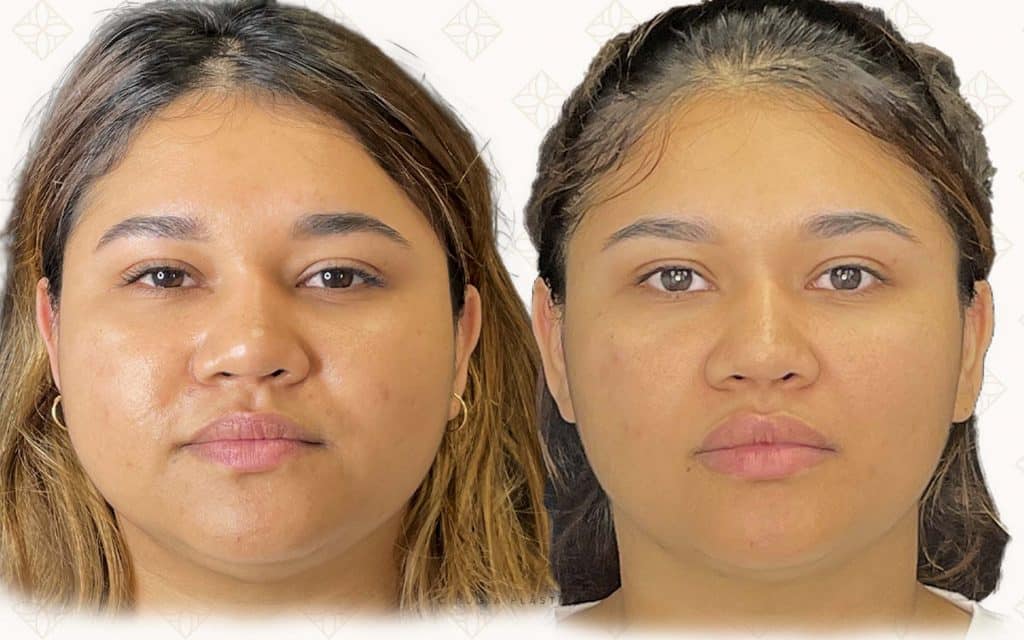 Frente antes y después de bichectomía en mujer, reducción del volumen en mejillas y rostro más estilizado