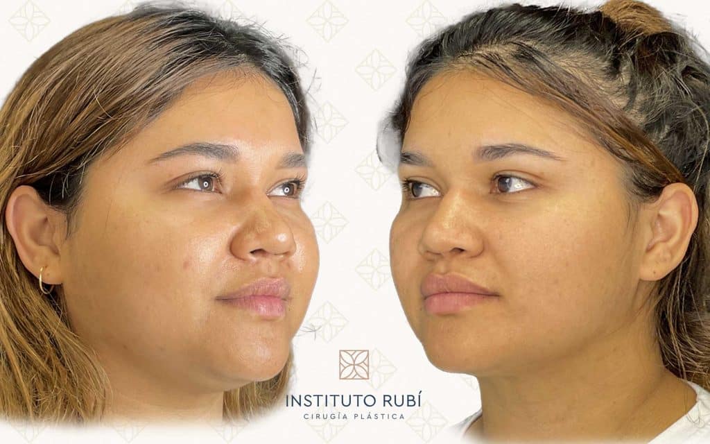 Lado resultado de bichectomía en rostro femenino, afinamiento de mejillas y contorno facial más definido