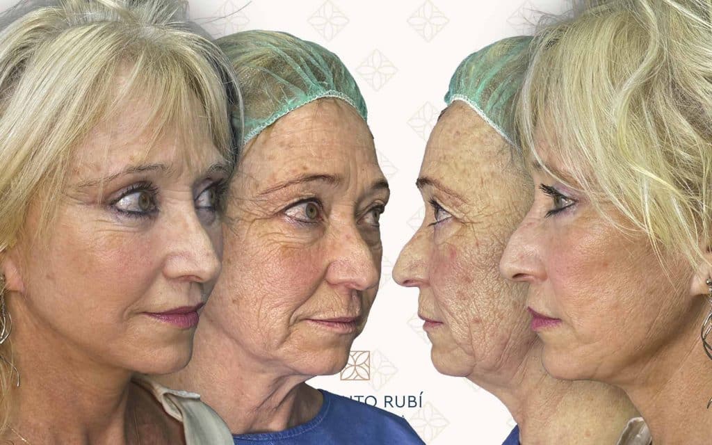 Lado y perfil-3 comparativa antes y después de lifting facial en Barcelona en mujer mayor, mostrando reducción de arrugas, flacidez y líneas de expresión