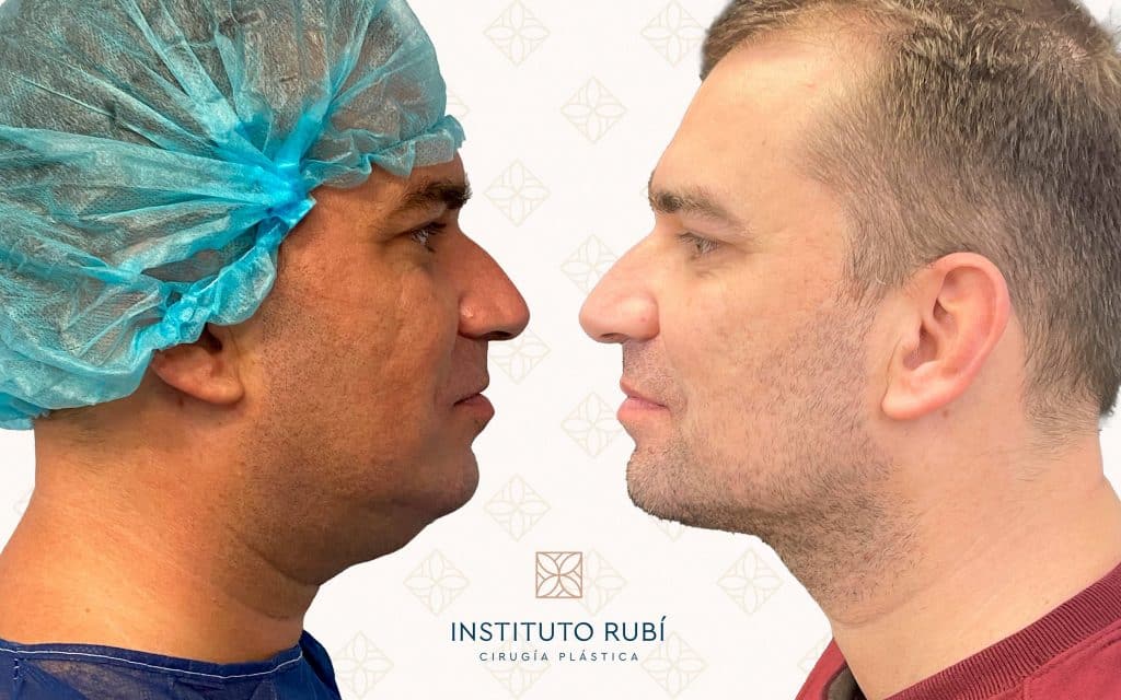 Lipo de papada perfil resultado de liposucción de papada en hombre, perfil antes y después con mandíbula más definida y reducción de grasa submentoniana.