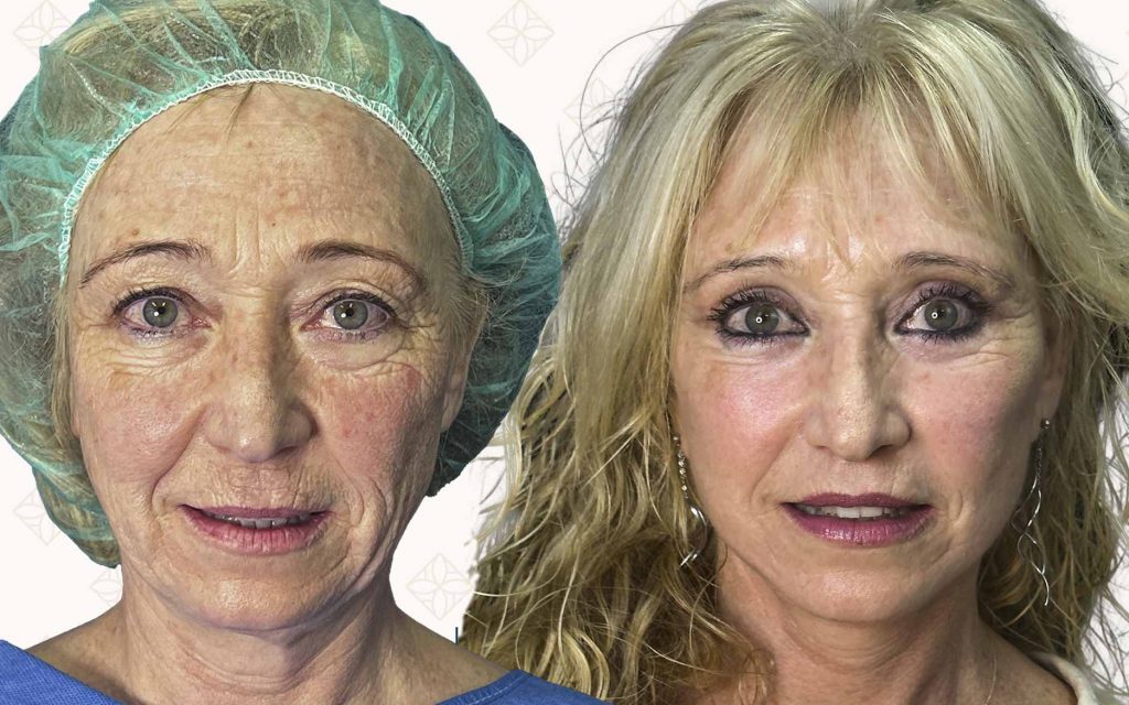 frente-3 antes y después de lifting facial en Barcelona en mujer mayor, con mejora visible en firmeza de la piel y rejuvenecimiento del rostro
