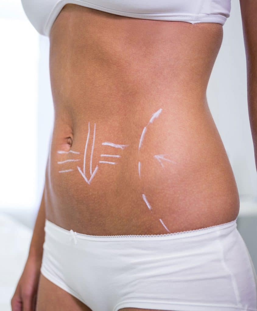 lipofilling2 La imagen muestra el abdomen y parte de la cadera de una mujer con marcas quirúrgicas dibujadas con marcador blanco, típicas de una planificación para un procedimiento estético como una liposucción o abdominoplastia. La paciente lleva ropa interior blanca y la fotografía parece haber sido tomada en un entorno clínico o consultorio médico