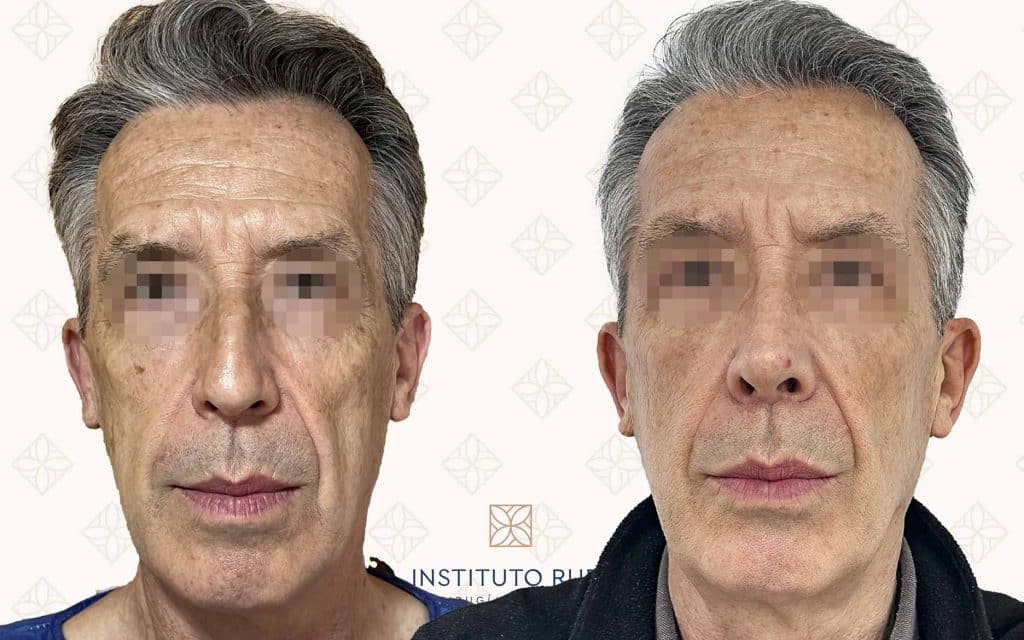 Frente-17 Fotografía comparativa de frente del antes y después de una rinoplastia en paciente masculino en Instituto Rubí, con resultados que muestran un rostro más simétrico y rejuvenecido.