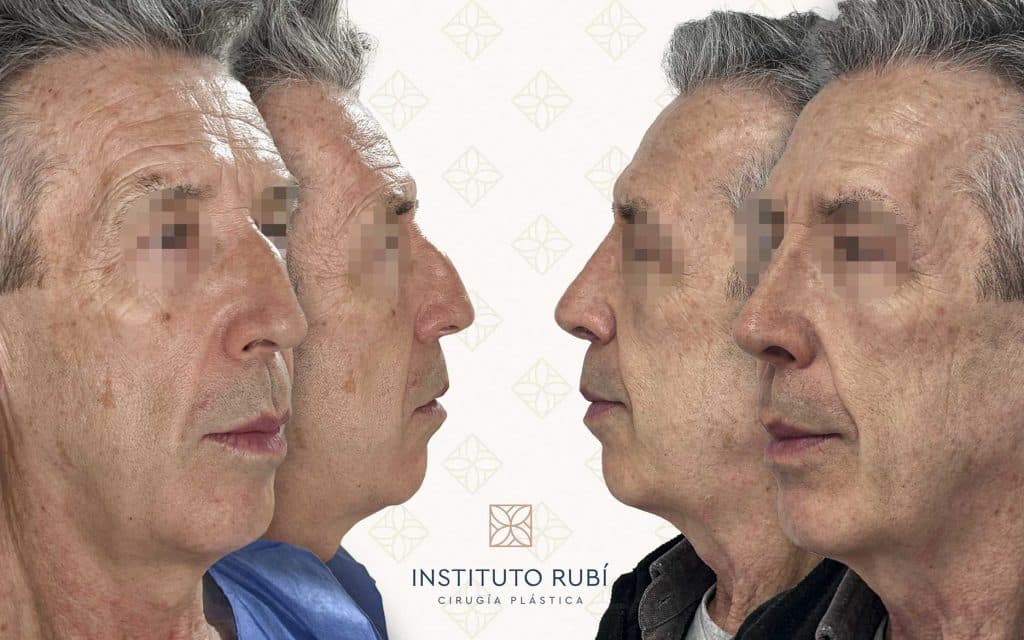 Lado y perfil-17 Fotografía de perfil comparativa del antes y después de una rinoplastia en paciente masculino en Instituto Rubí, donde se aprecia una notable armonización del rostro gracias a la corrección del puente y la punta nasal.
