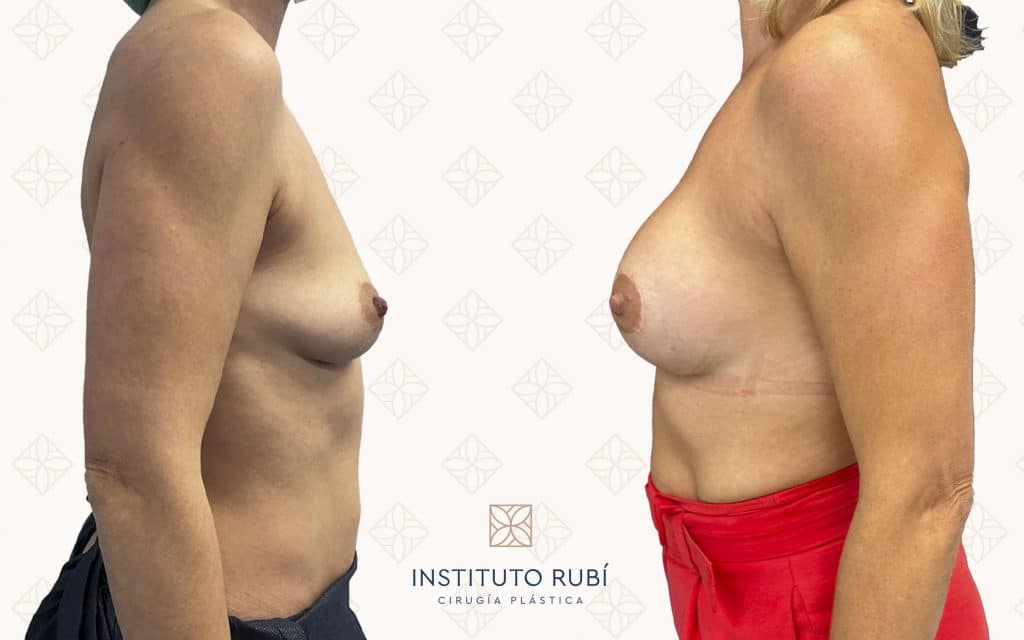 Perfil-3 Comparativa antes y después de un aumento de pecho realizado en Instituto Rubí, donde se aprecia un resultado natural con mayor volumen y proyección, adaptado a la anatomía de la paciente.