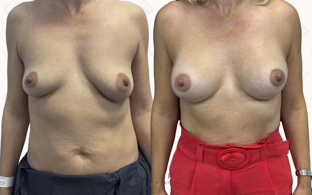 frente-3 Comparativa de antes y después de un aumento mamario realizado en Instituto Rubí, donde se aprecia una mejora en el volumen, la simetría y la firmeza del busto, logrando un resultado natural y armonioso.