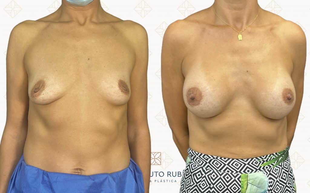 frente-4 Resultados de una cirugía de aumento de pecho en Instituto Rubí, logrando una forma más redondeada y simétrica que realza el contorno corporal y mejora la proyección del busto.