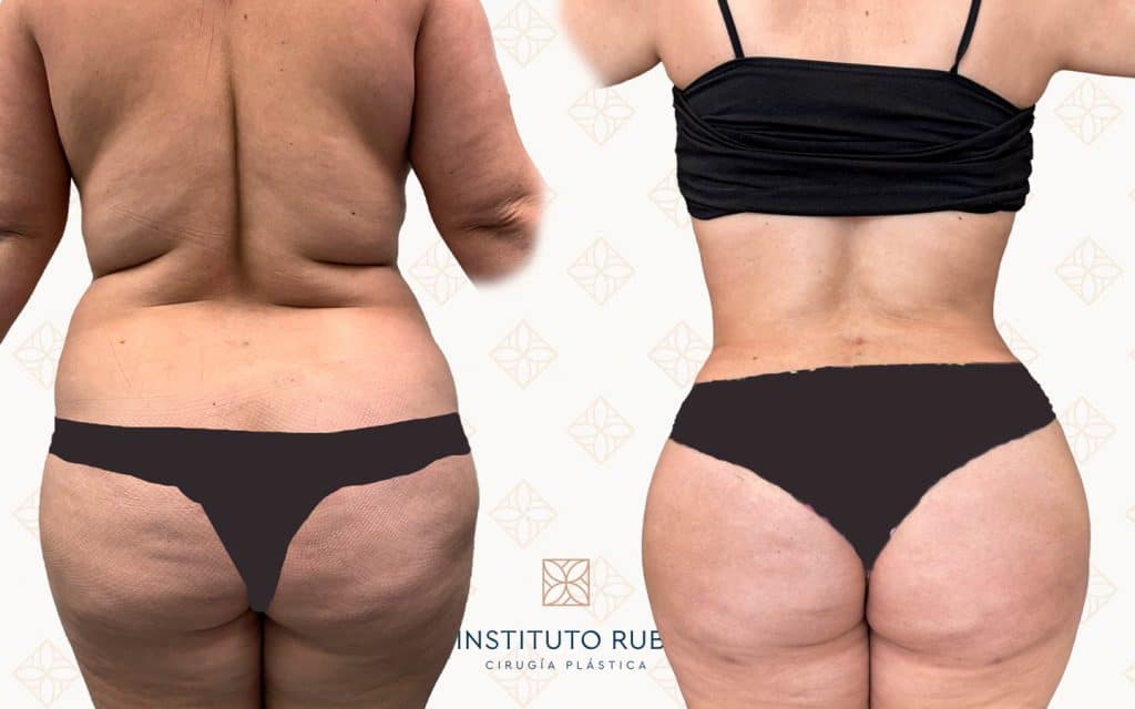 atrás abdominoplastia barcelona