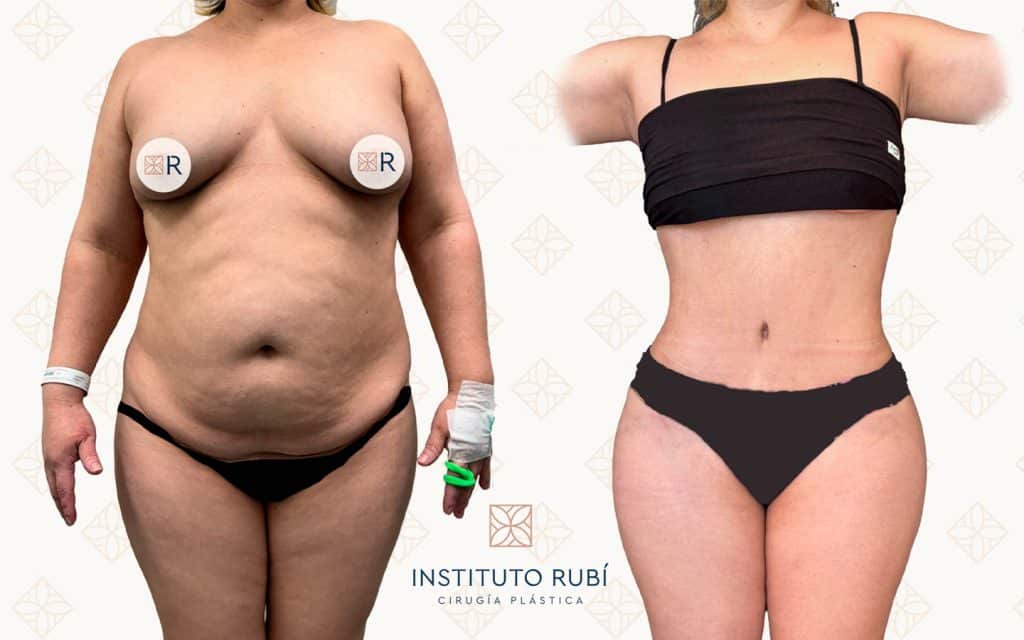frente abdominoplastia barcelona