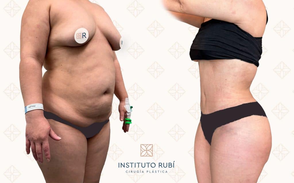 lado abdominoplastia barcelona