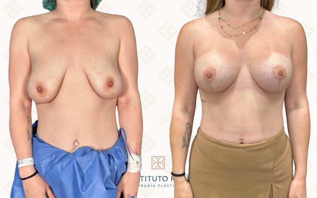 Frente Antes y después de una mastopexia con prótesis en paciente de pecho caído atendida en nuestra clínica de cirugía plástica en Mallorca