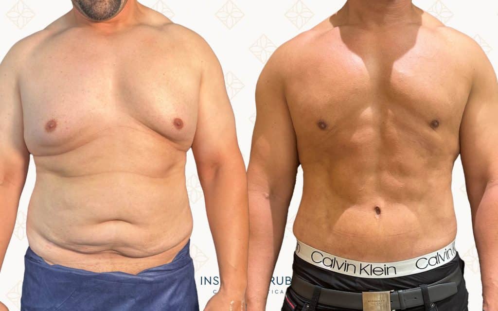 Comparaciones Frente-3 Antes y después de una marcación abdominal masculina con liposucción de alta definición para eliminar grasa localizada y definir abdominales en hombres