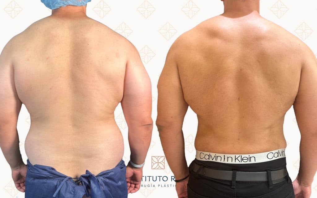 Comparaciones atrás Transformación del torso masculino tras liposucción para eliminar grasa localizada en espalda y flancos y conseguir una silueta más atlética y definida