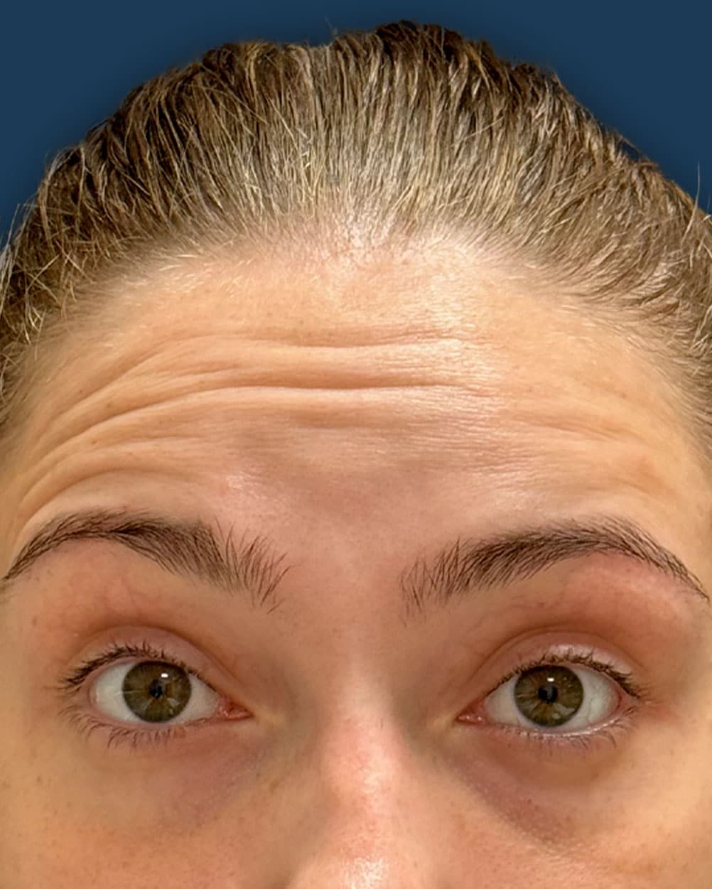 Arrugas dinámicas en frente antes de tratamiento con toxina botulínica. Paciente candidata a bótox para alisar líneas de expresión y elevar la mirada en Instituto Rubí
