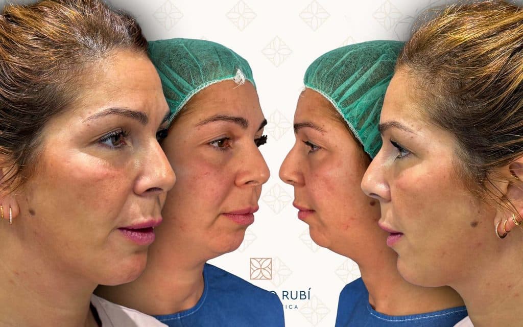 Antes-y-después-mentoplastia Antes y después de mentoplastia en paciente adulta. Resultados tras tratamiento integral con lifting, liposucción de papada y rellenos faciales en Instituto Rubí