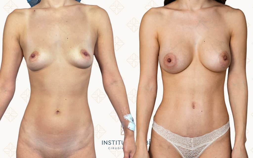 frente-2 Antes y después de aumento de pecho con técnica ABA en Madrid. Resultados naturales y armónicos en Instituto Rubí, especialistas en cirugía mamaria personalizada