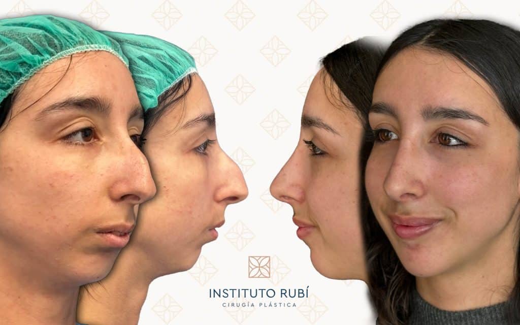 Lado y perfil Antes y después de rinoplastia estética en paciente femenina. Comparativa del perfil y ángulo nasolabial tras cirugía de nariz en Instituto Rubí, especializada en armonización facial