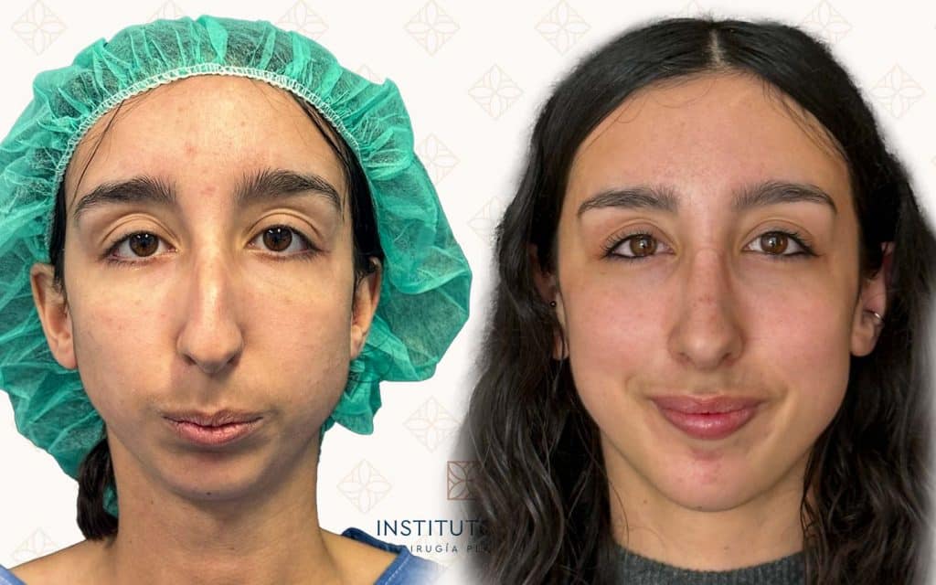 frente Antes y después de rinoplastia estética frontal en paciente mujer. Resultado natural con armonía facial tras cirugía de nariz realizada en Instituto Rubí