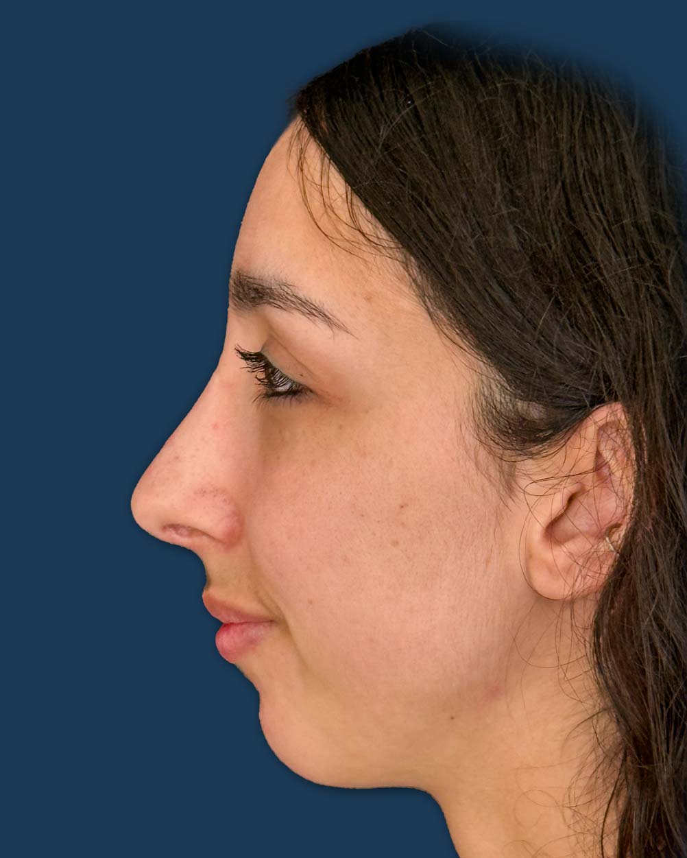 Resultado de rinoplastia estética en paciente femenina. Perfil armónico con corrección de dorso nasal prominente y refinamiento de la punta tras cirugía de nariz