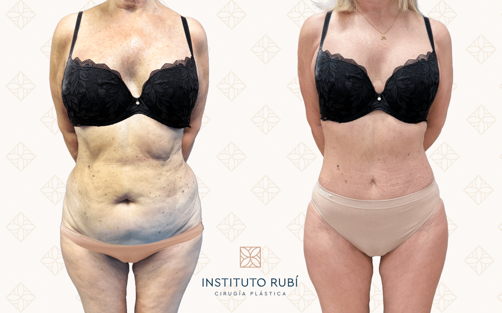 Frente abdominoplastia barcelona