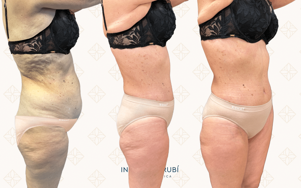 perfil abdominoplastia canarias