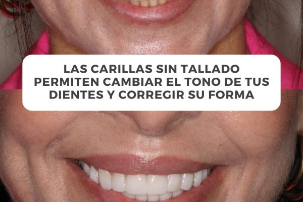 Nuestra paciente vino con una idea clara- quería verse mejor y sentirse más segura con su sonris (2)