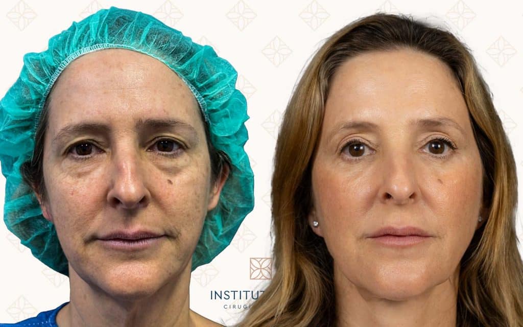 frente blefaroplastia madrid