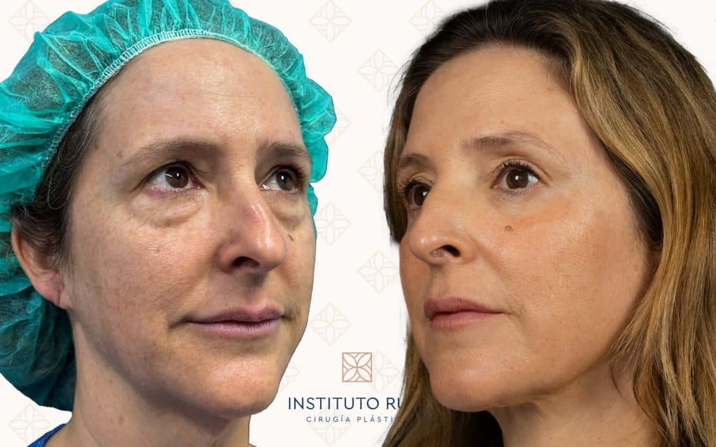 lado blefaroplastia mallorca
