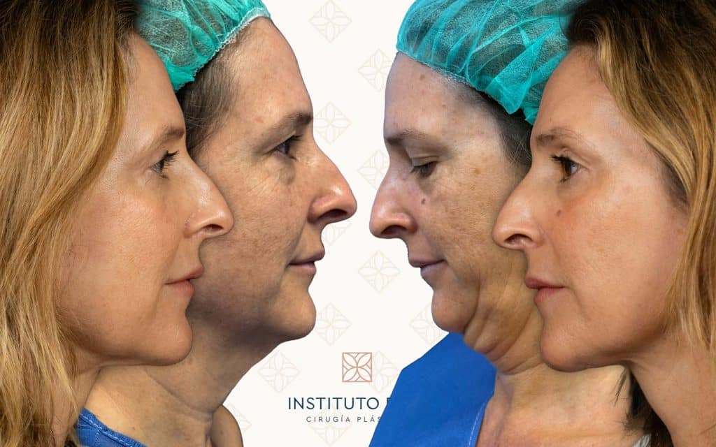 perfil lifting de cuello mallorca