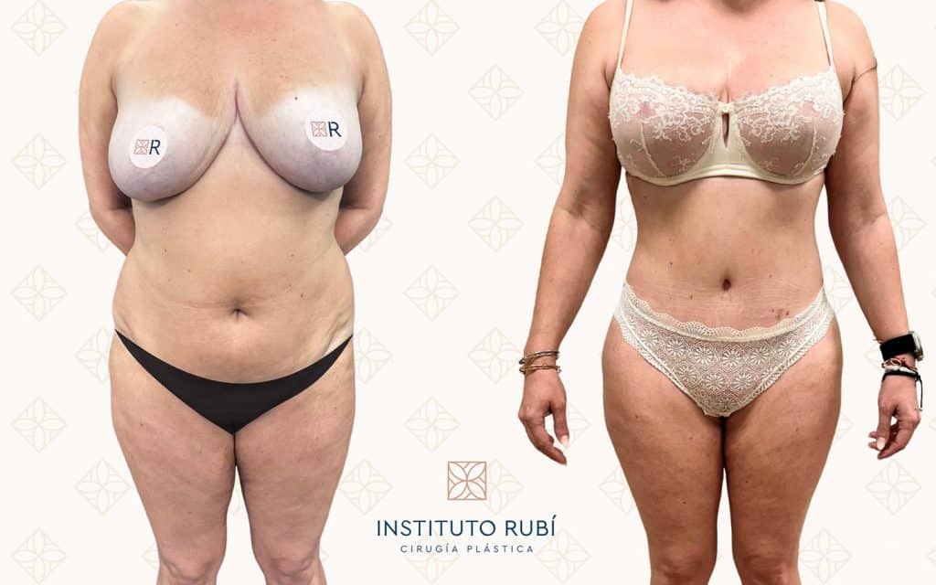 Antes-y-después-mommy-makeover1 mommy makeover madrid