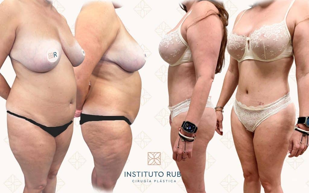 Antes-y-después-mommy-makeover2 mommy makeover canarias