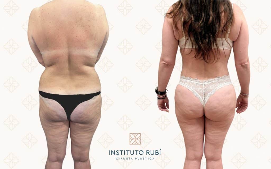 Antes-y-después-mommy-makeover3 mommy makeover canarias