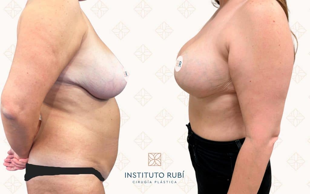 Comparación-Perfil6 la mejor mastopexia mallorca