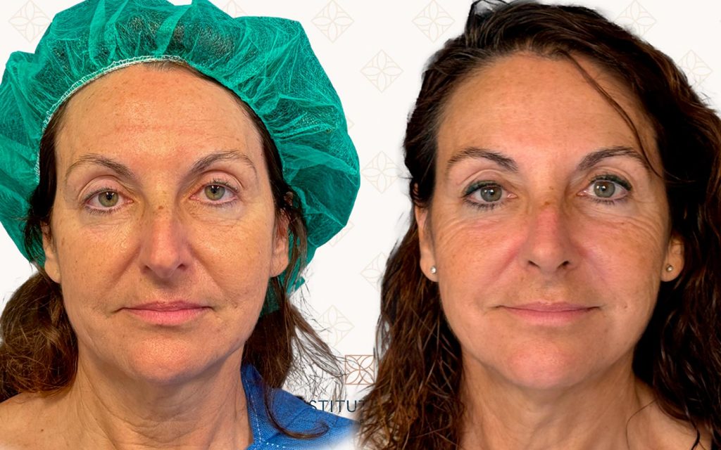 Frente-18 la mejor rinoplastia mallorca