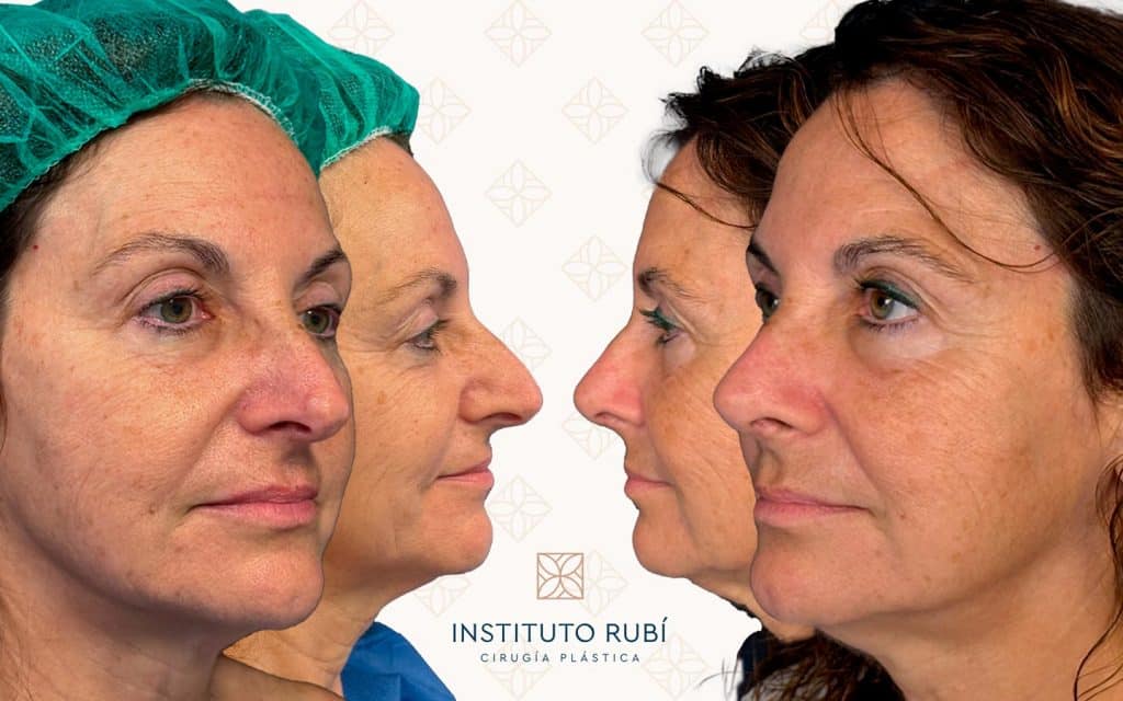 Lado-y-perfil-18 la mejor rinoplastia mallorca