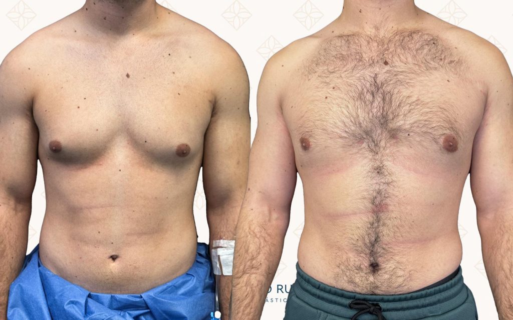 cirugia-de-ginecomastia7 ginecomastia alicante