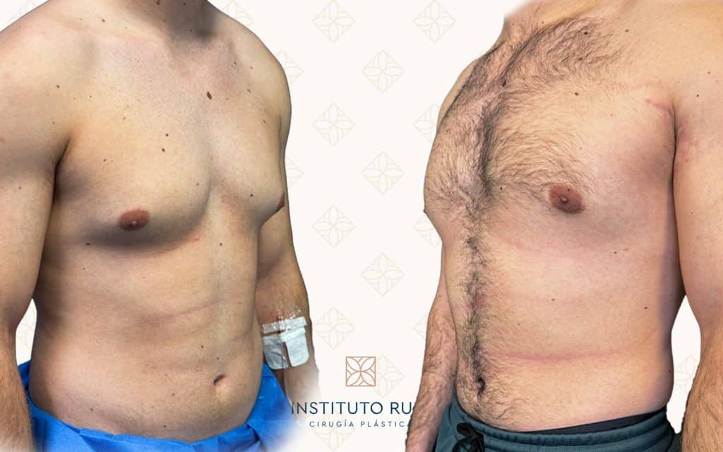 cirugia-de-ginecomastia8 ginecomastia alicante