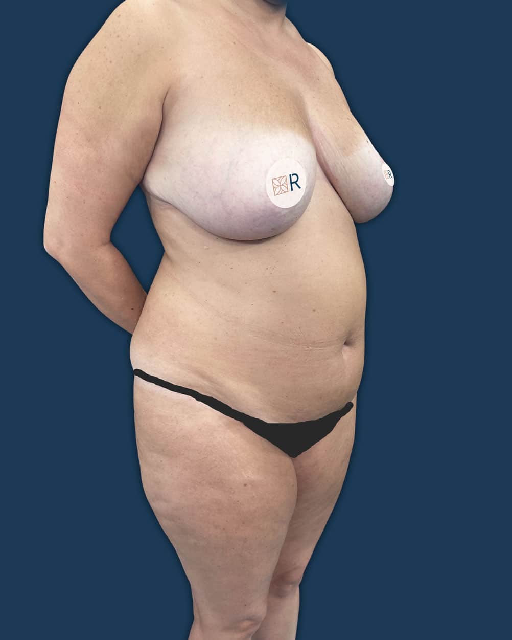 mommy makeover mallorca