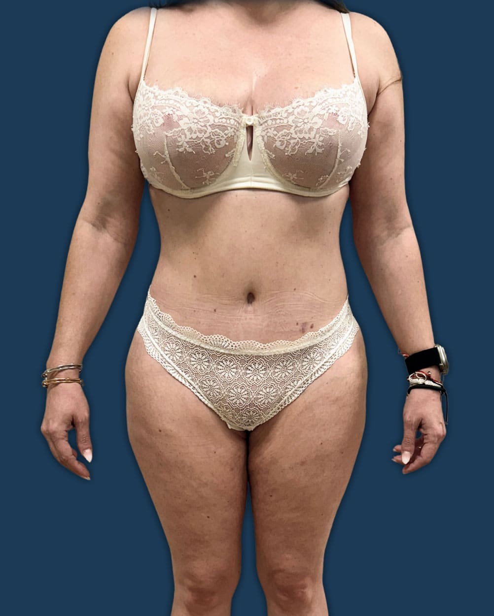 mommy makeover mallorca