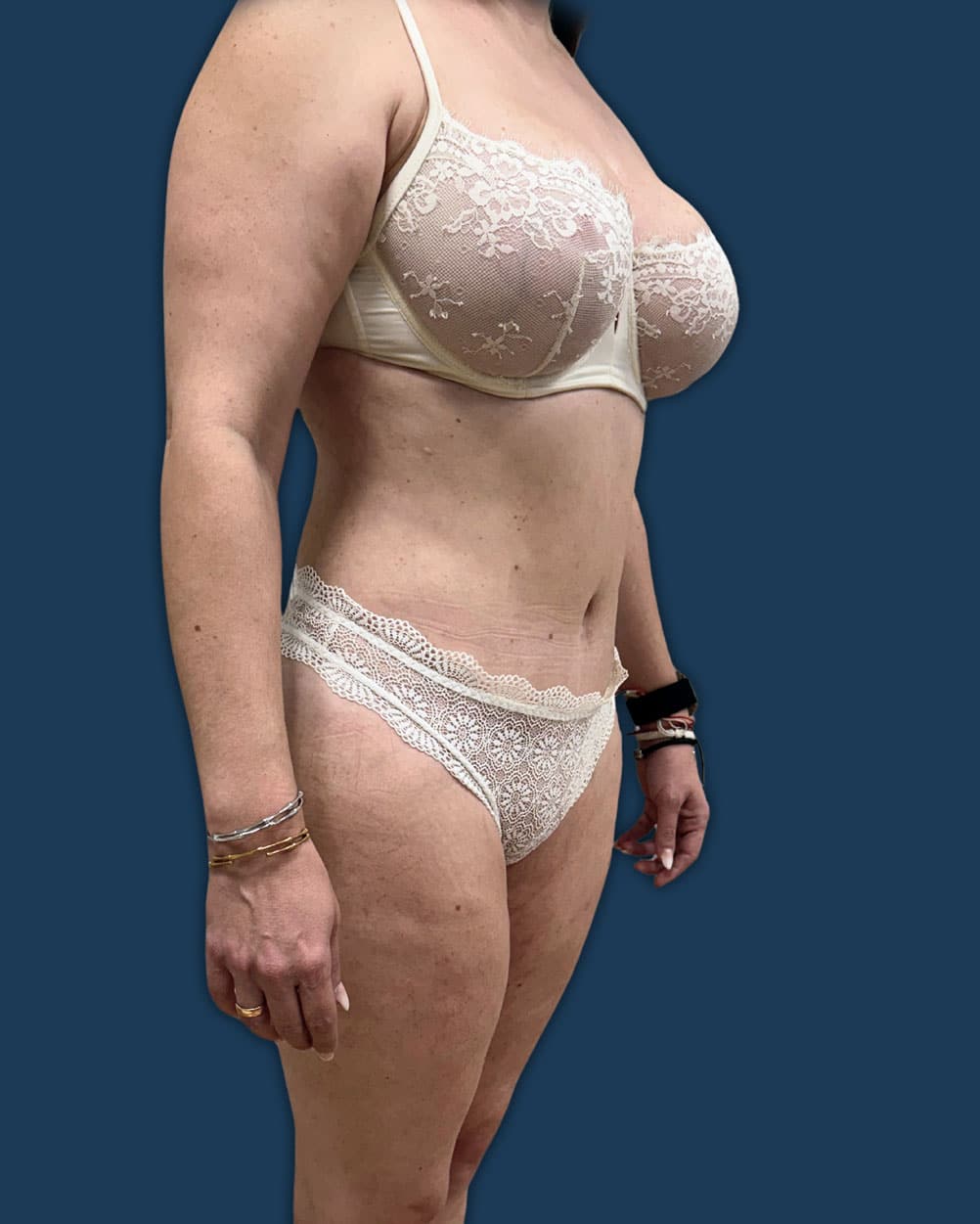 mommy makeover madrid