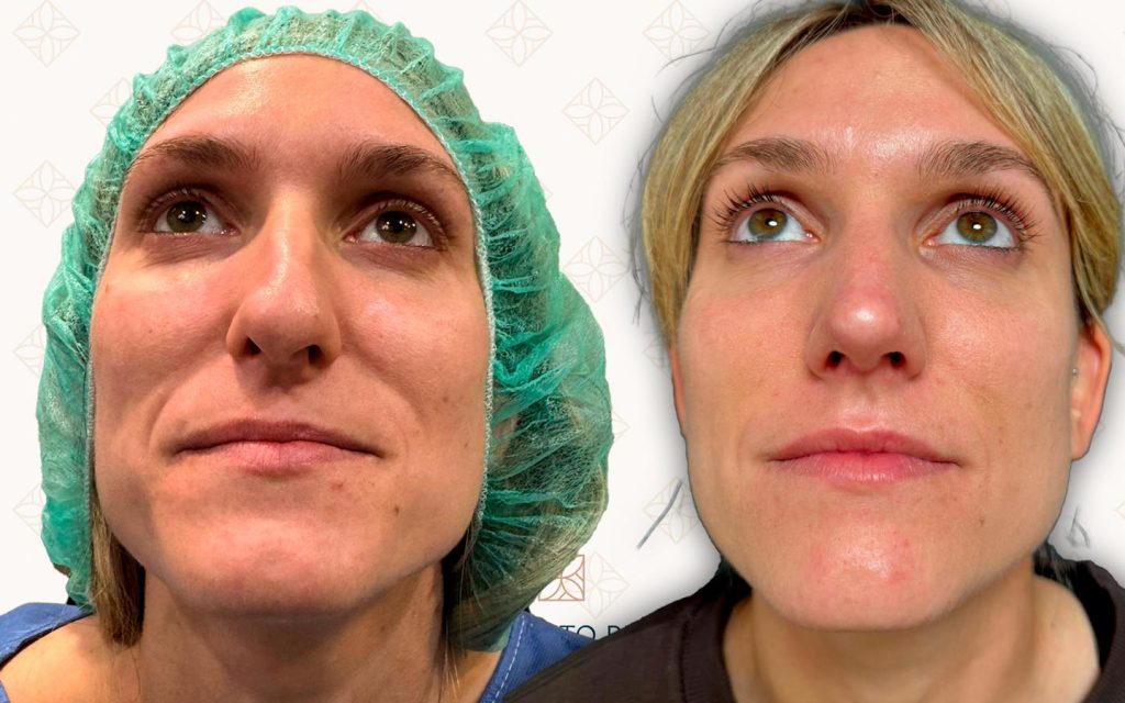 Frente-19 rinoseptoplastia mallorca