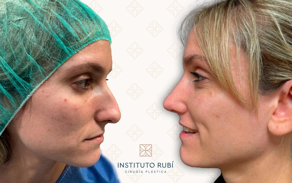 perfil-18 rinoseptoplastia mallorca