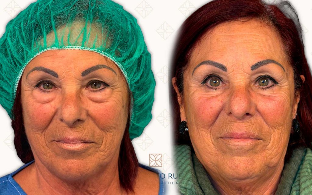 Comparación-Blefaroplastia-Frente svg+xml;charset=utf