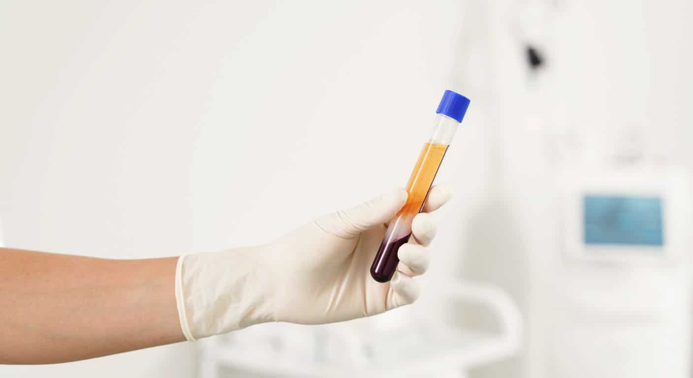 Recambio plasmático terapéutico: qué es y qué dice la evidencia científica