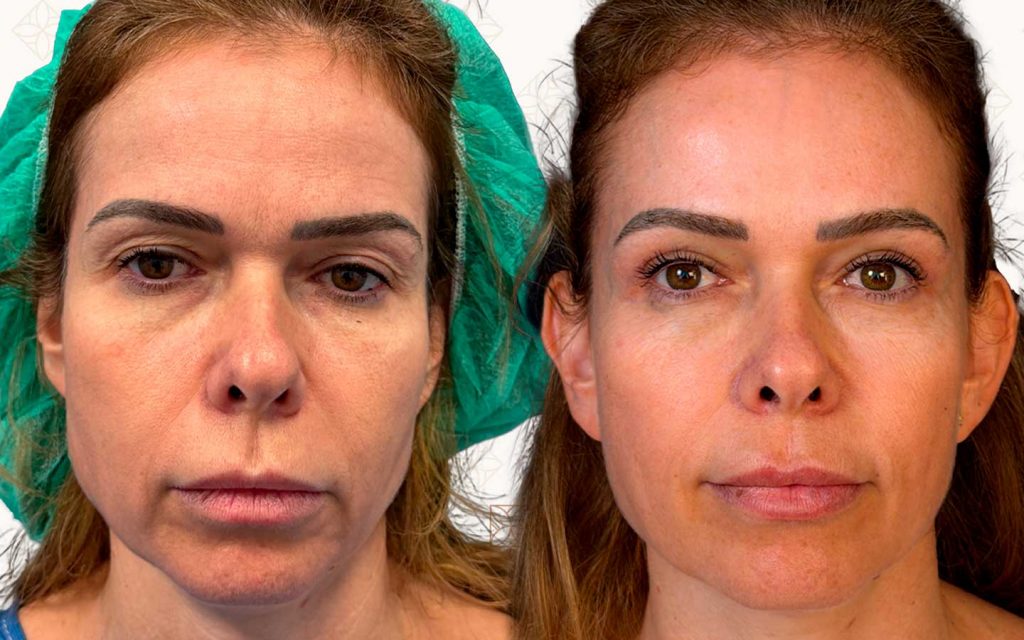 Comparación-Blefaroplastia-FrenteItziar Blefaroplastia Mallorca