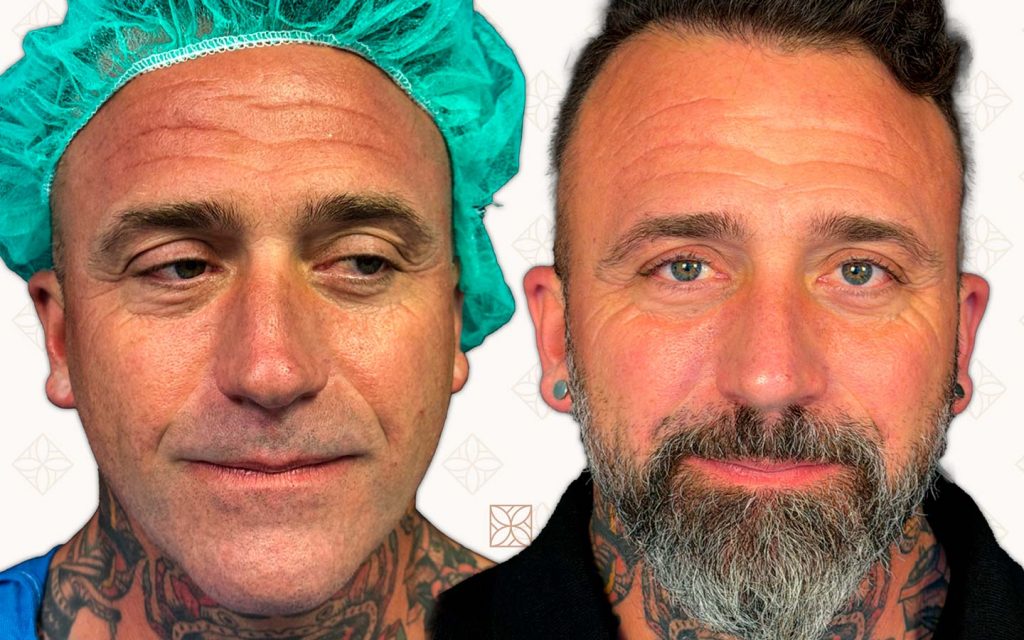 Frente-20 rinoplastia mallorca