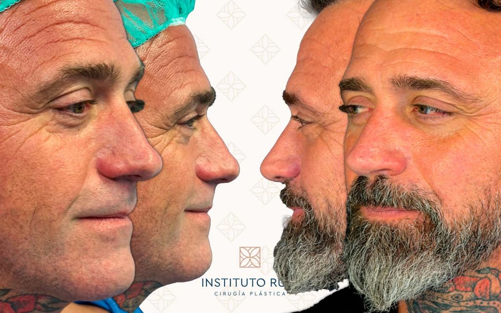 Lado-y-perfil-19 rinoplastia madrid